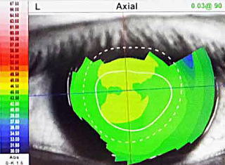 視力検査【視力1.0の見え方の質が見える】角膜形状/屈折力解析装置　OPD-Scan lll VS